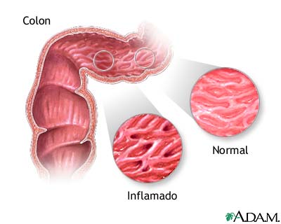 Intestino en Enfermedad Inflamatória Intestinal